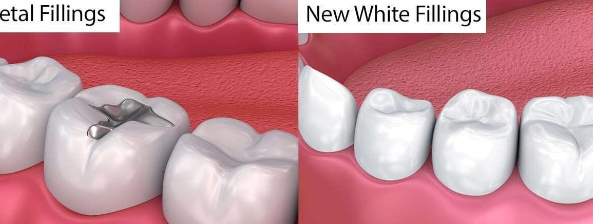 White Fillings
