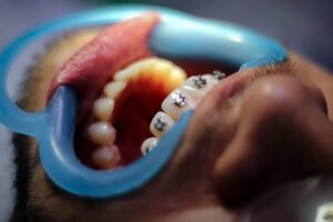 Clear aligner